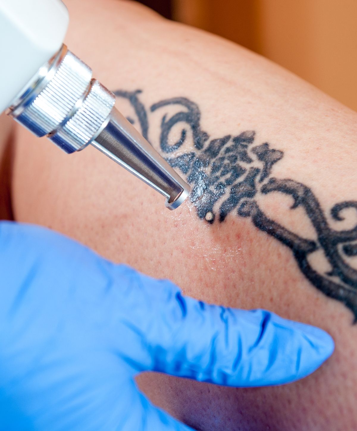 Tattoo removal procedure in progress.
